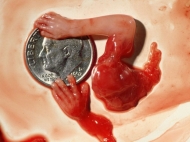 10 Week Abortion (05)